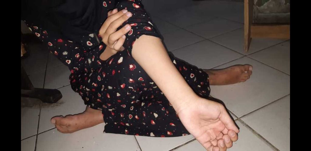 OLIN (16), penyintas upaya bunuh diri, menunjukkan luka bekas silet di tangannya ketika ditemui di Jakarta, Sabtu (4/7/2020).