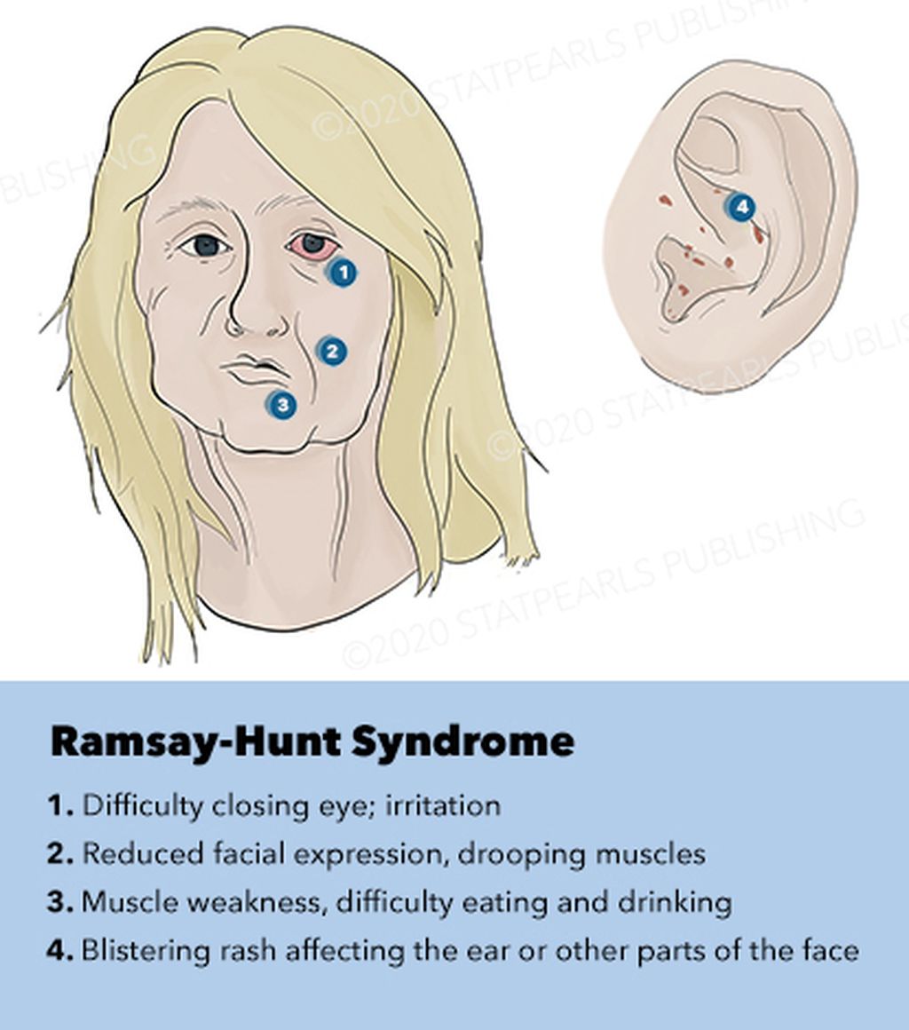 Ramsay-Hunt Syndrome. Grafis oleh Ella Workman. Sumber: www.ncbi.nlm.nih.gov/books/NBK557409/figure/article-22843.image.f4/?report=objectonly