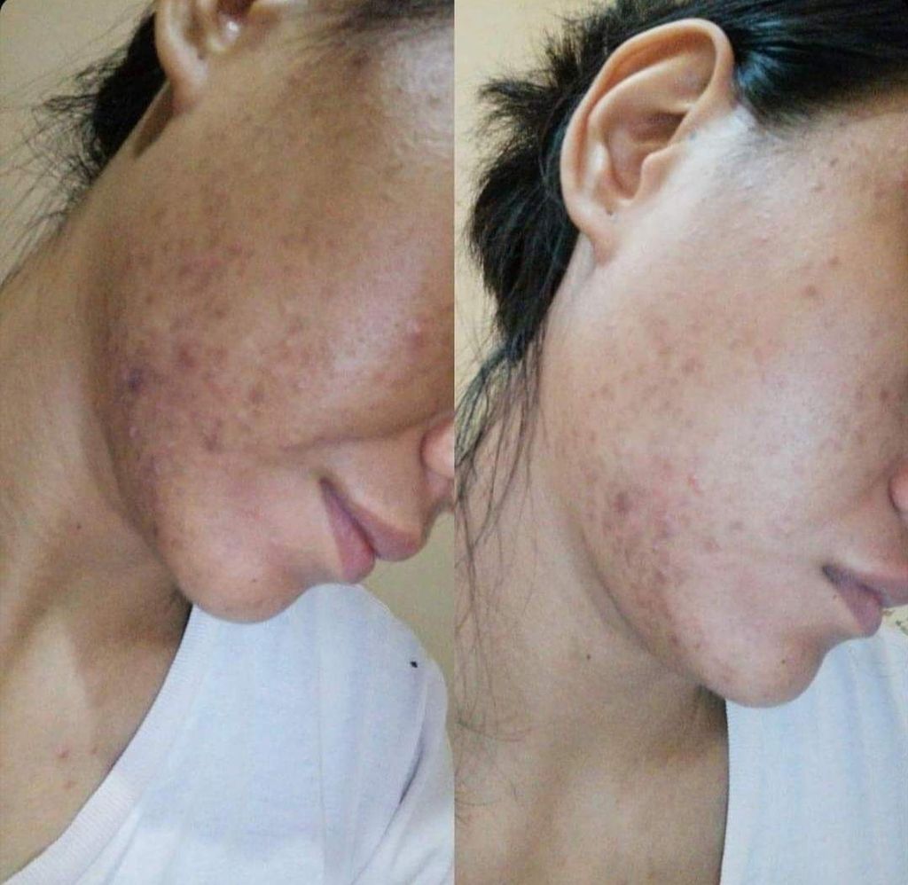 Kondisi jerawat di wajah Eliwati (27) akibat dua tahun memakai krim pemutih ilegal.